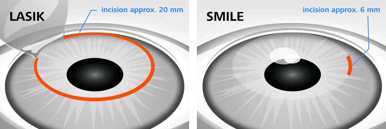 Confronto tra i metodi di correzione della visione laser LASIK e SMILE